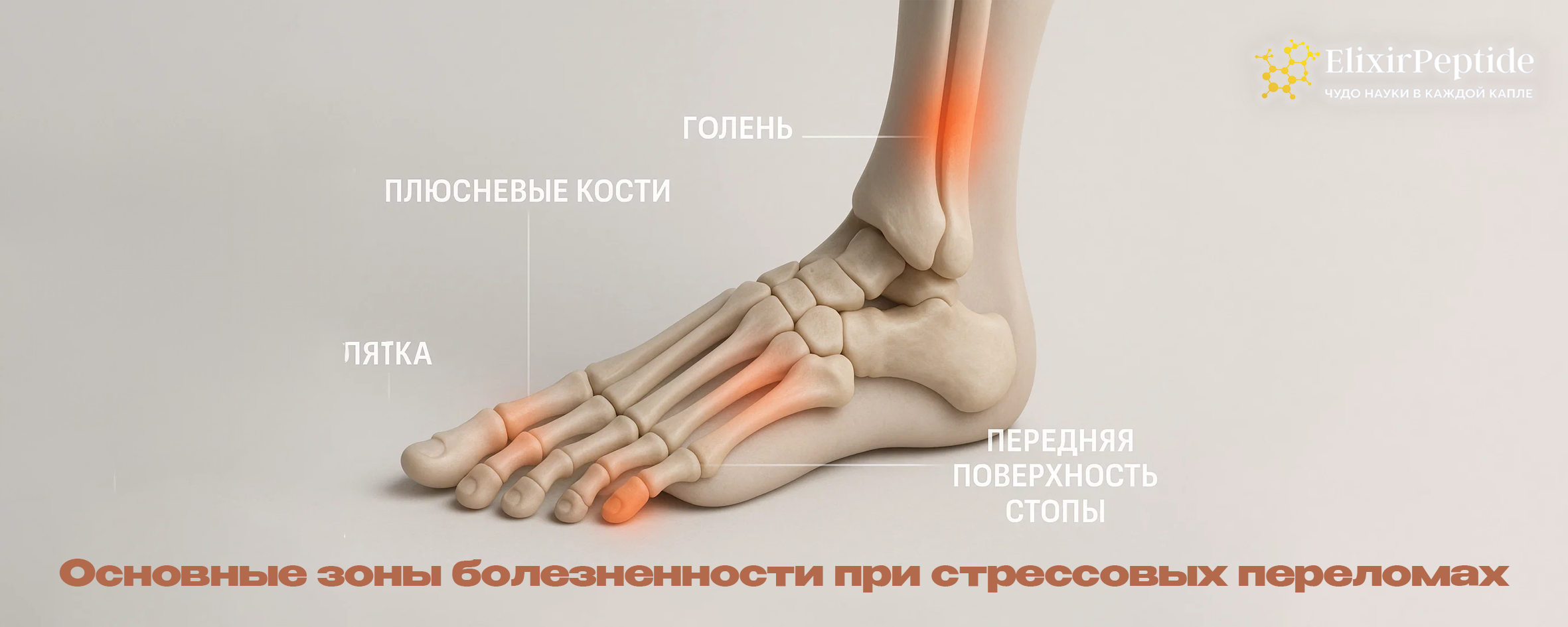 Основные зоны болезненности при стрессовых переломах